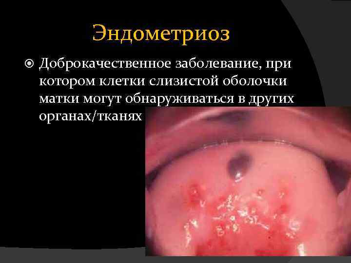 Эндометриоз Доброкачественное заболевание, при котором клетки слизистой оболочки матки могут обнаруживаться в других органах/тканях