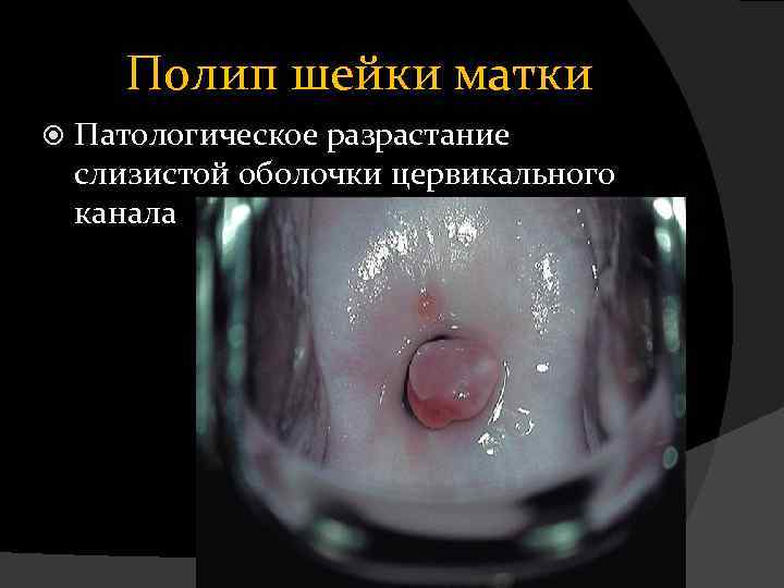 Полип шейки матки Патологическое разрастание слизистой оболочки цервикального канала 