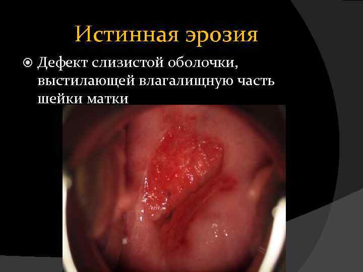 Истинная эрозия Дефект слизистой оболочки, выстилающей влагалищную часть шейки матки 