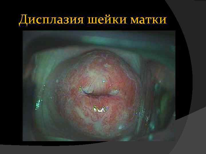 Дисплазия шейки матки 