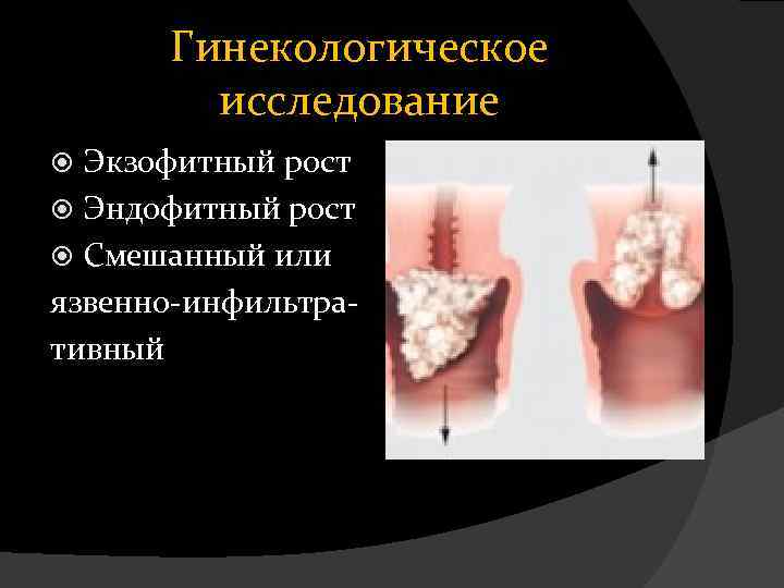 Гинекологическое исследование Экзофитный рост Эндофитный рост Смешанный или язвенно-инфильтративный 