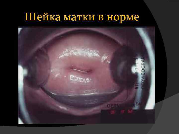 Шейка матки в норме 