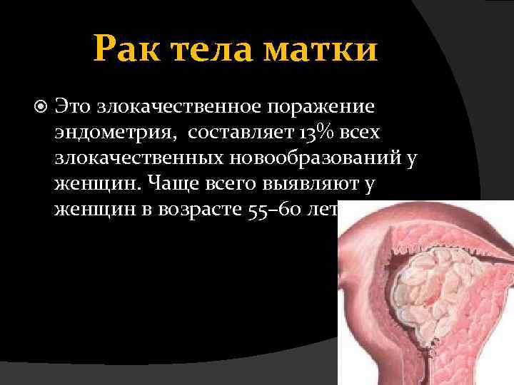 Рак тела матки Это злокачественное поражение эндометрия, составляет 13% всех злокачественных новообразований у женщин.