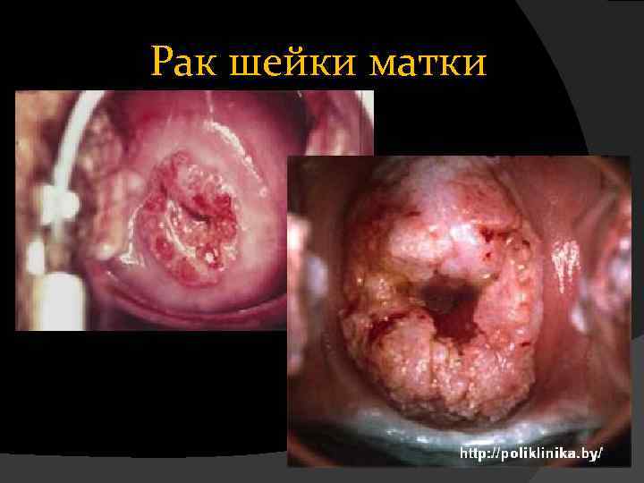Рак шейки матки 