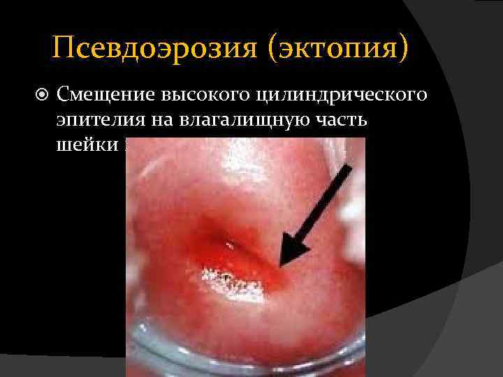 Псевдоэрозия (эктопия) Смещение высокого цилиндрического эпителия на влагалищную часть шейки матки 