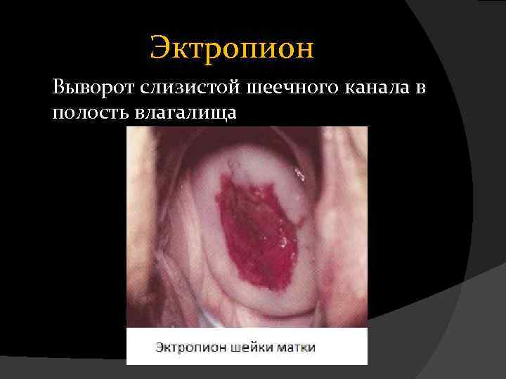 Эктропион Выворот слизистой шеечного канала в полость влагалища 