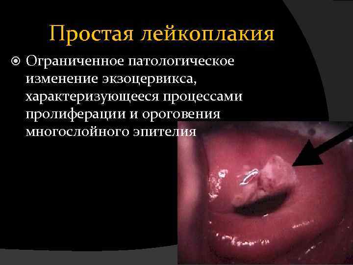 Простая лейкоплакия Ограниченное патологическое изменение экзоцервикса, характеризующееся процессами пролиферации и ороговения многослойного эпителия 