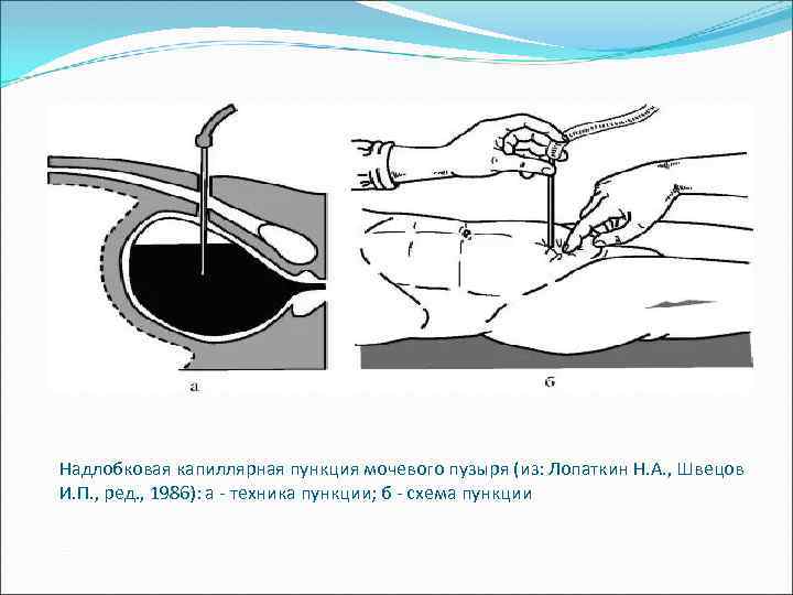 Надлобковая капиллярная пункция мочевого пузыря (из: Лопаткин Н. А. , Швецов И. П. ,