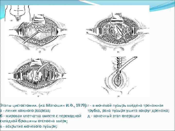 Этапы цистостомии. (из: Матюшин И. Ф. , 1979): г - в мочевой пузырь введена