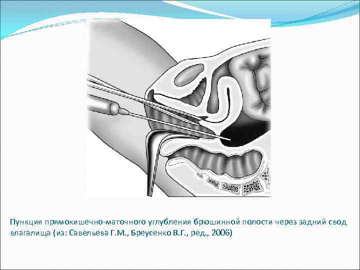 Пункция прямокишечно-маточного углубления брюшинной полости через задний свод влагалища (из: Савельева Г. М. ,