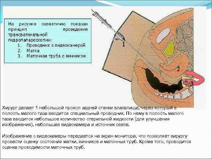 Хирург делает 1 небольшой прокол задней стенки влагалища, через который в полость малого таза