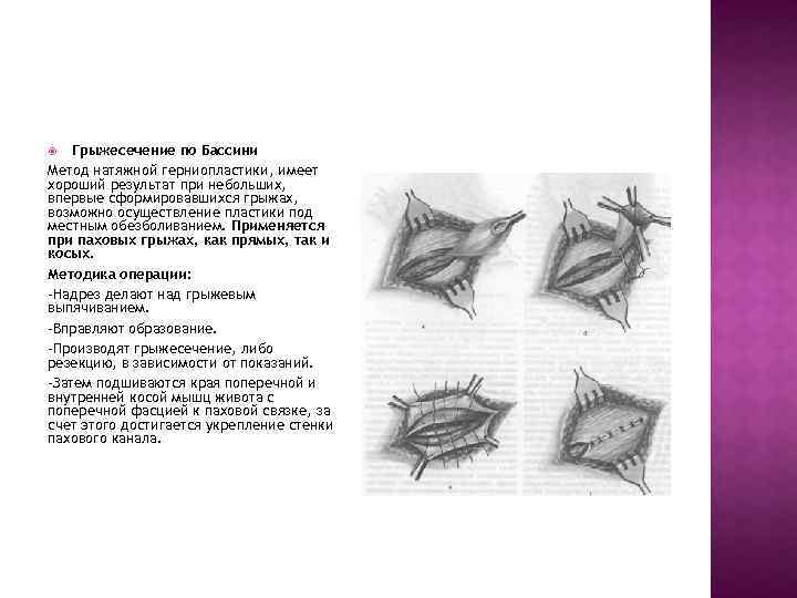 Грыжесечение по Бассини Метод натяжной герниопластики, имеет хороший результат при небольших, впервые сформировавшихся грыжах,