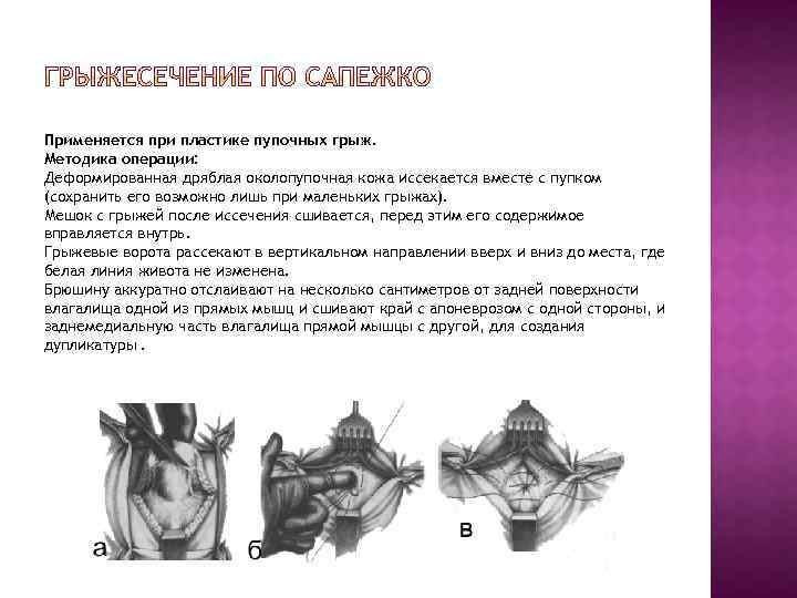 Применяется при пластике пупочных грыж. Методика операции: Деформированная дряблая околопупочная кожа иссекается вместе с