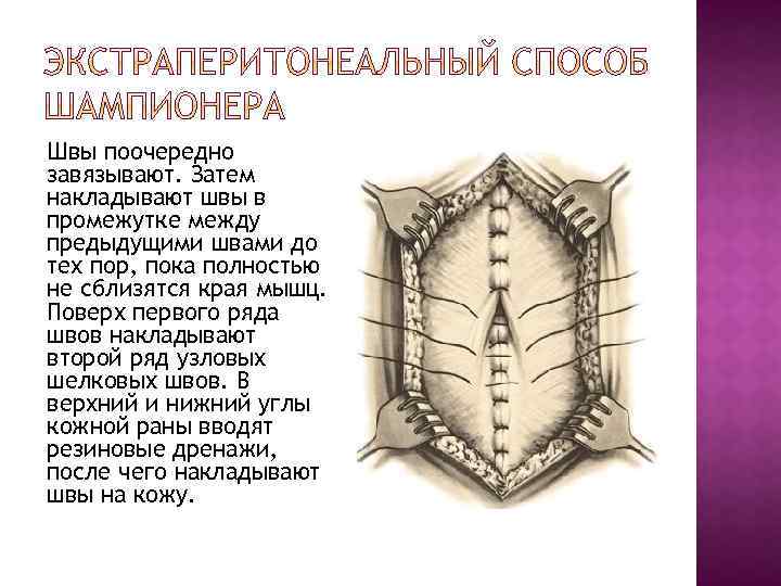 Швы поочередно завязывают. Затем накладывают швы в промежутке между предыдущими швами до тех пор,