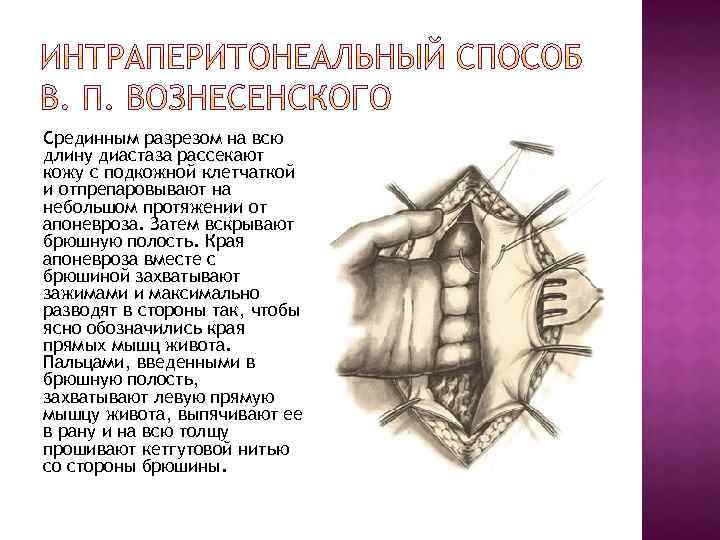 Срединным разрезом на всю длину диастаза рассекают кожу с подкожной клетчаткой и отпрепаровывают на