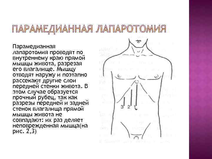 Парамедианная лапаротомия проводят по внутреннему краю прямой мышцы живота, разрезая его влагалище. Мышцу отводят