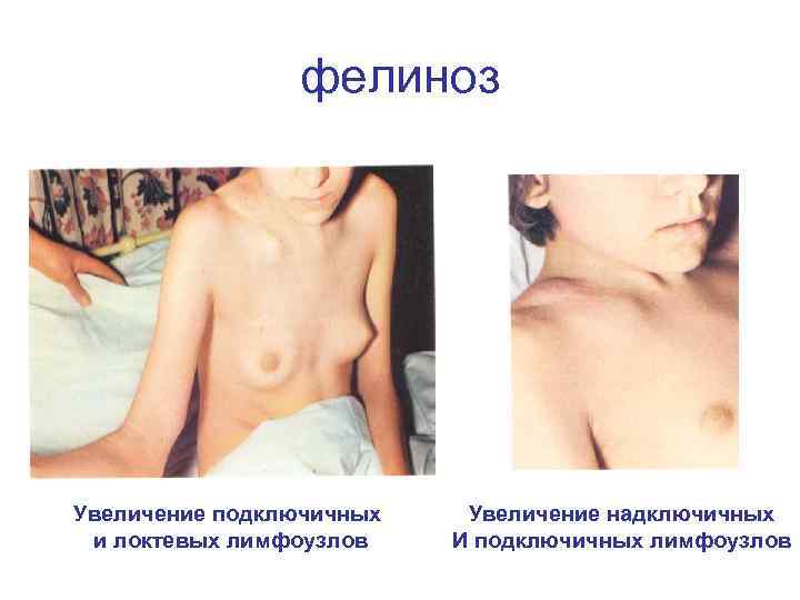 фелиноз Увеличение подключичных и локтевых лимфоузлов Увеличение надключичных И подключичных лимфоузлов 