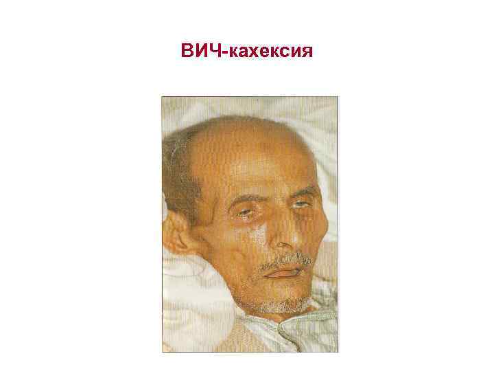 ВИЧ-кахексия 