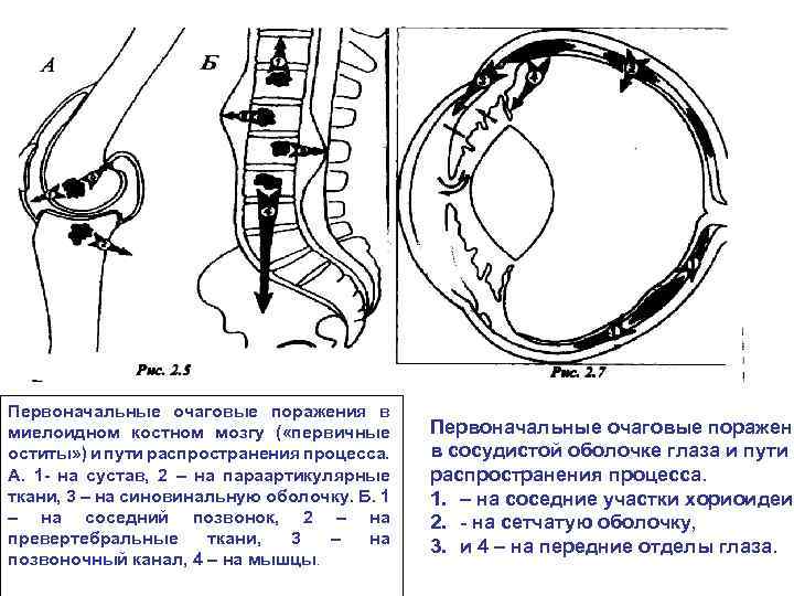 Клиническая картина и течение вич ассоциированного туберкулеза в основном обусловлены