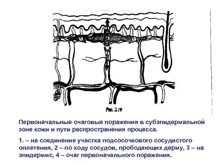 Первоначальные очаговые поражения в субэпидермальной зоне кожи и пути распространения процесса. 1. – на