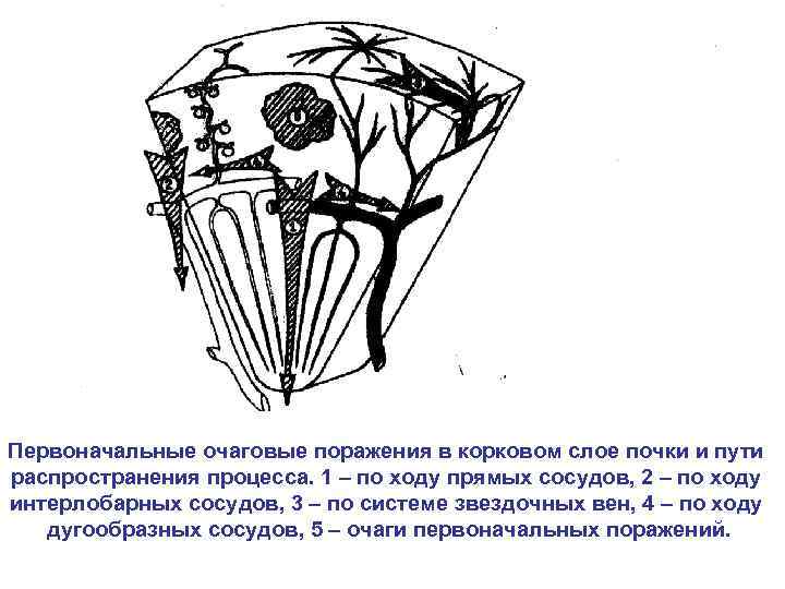 Первоначальные очаговые поражения в корковом слое почки и пути распространения процесса. 1 – по