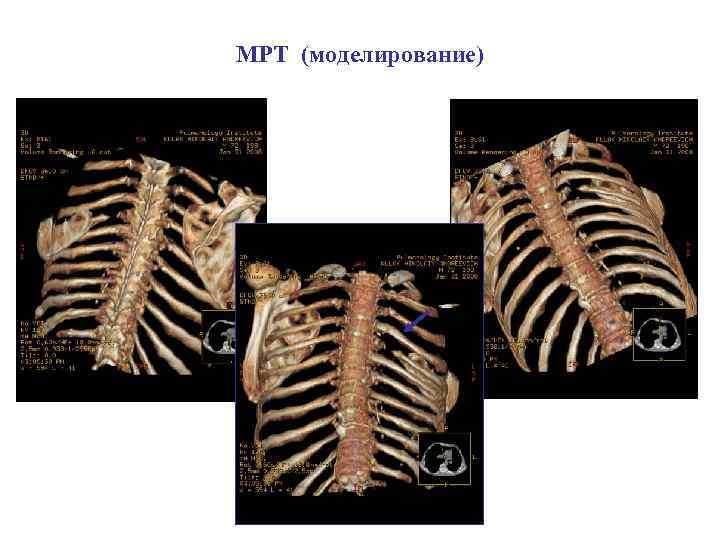 МРТ (моделирование) 