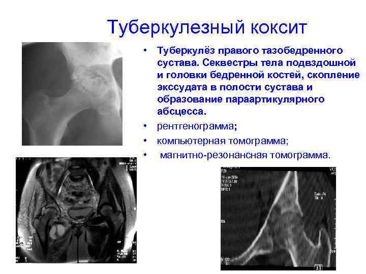  Туберкулезный коксит • Туберкулёз правого тазобедренного сустава. Секвестры тела подвздошной и головки бедренной