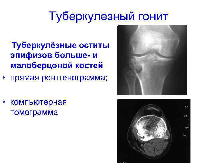 Туберкулезный гонит Туберкулёзные оститы эпифизов больше- и малоберцовой костей • прямая рентгенограмма; • компьютерная