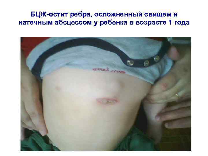 БЦЖ-остит ребра, осложненный свищем и натечным абсцессом у ребенка в возрасте 1 года 