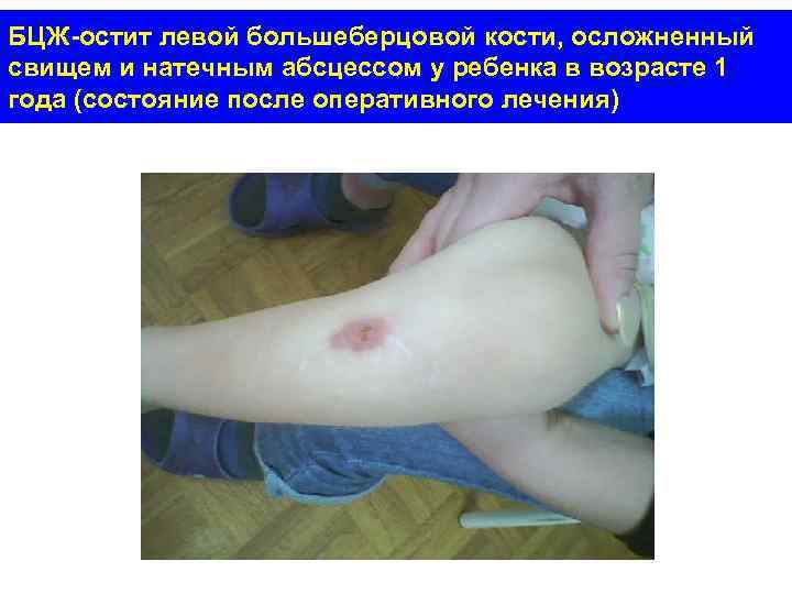 БЦЖ-остит левой большеберцовой кости, осложненный свищем и натечным абсцессом у ребенка в возрасте 1