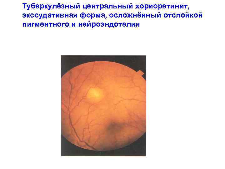  Туберкулёзный центральный хориоретинит, экссудативная форма, осложнённый отслойкой пигментного и нейроэндотелия 