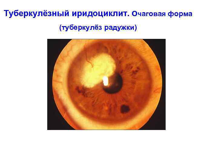 Туберкулёзный иридоциклит. Очаговая форма (туберкулёз радужки) 
