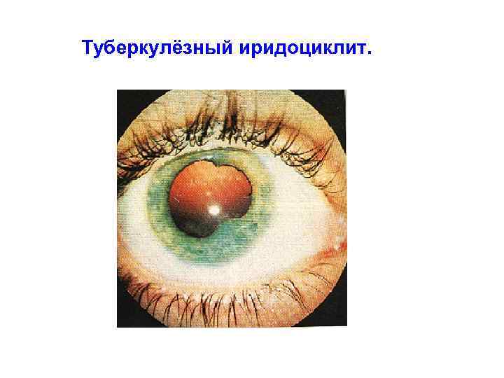 Туберкулёзный иридоциклит. 