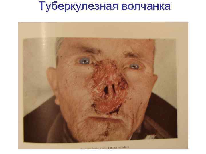 Туберкулезная волчанка 