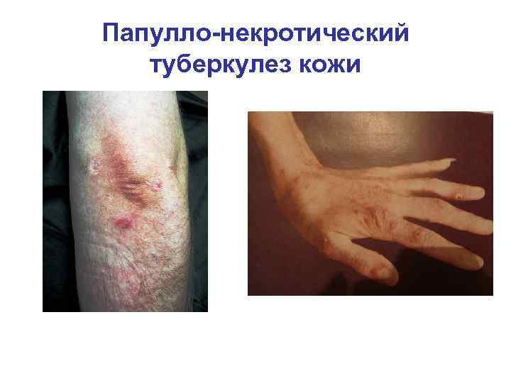 Папулло-некротический туберкулез кожи 