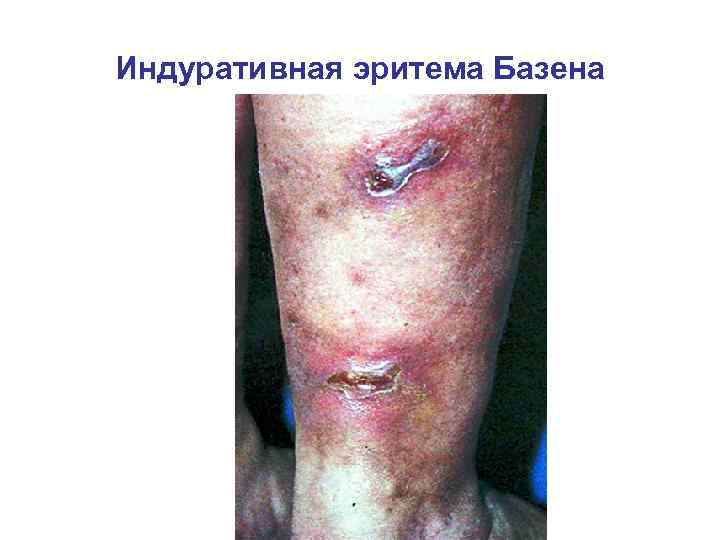 Индуративная эритема Базена 