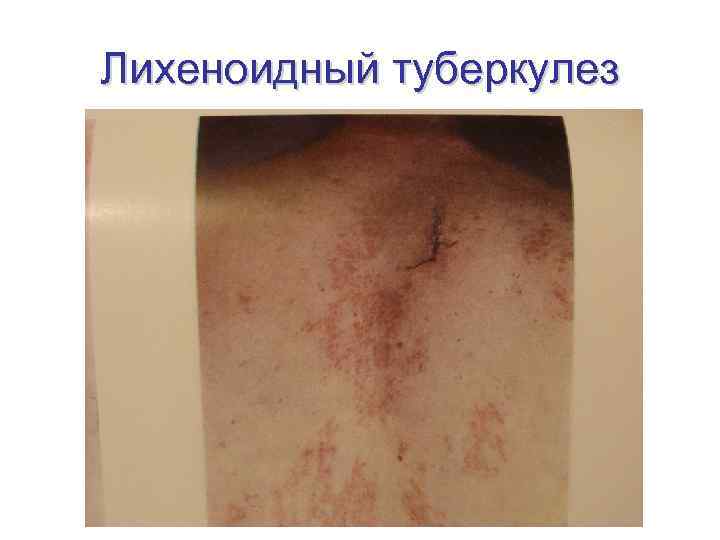 Лихеноидный туберкулез 