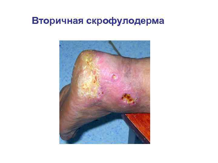 Вторичная скрофулодерма 