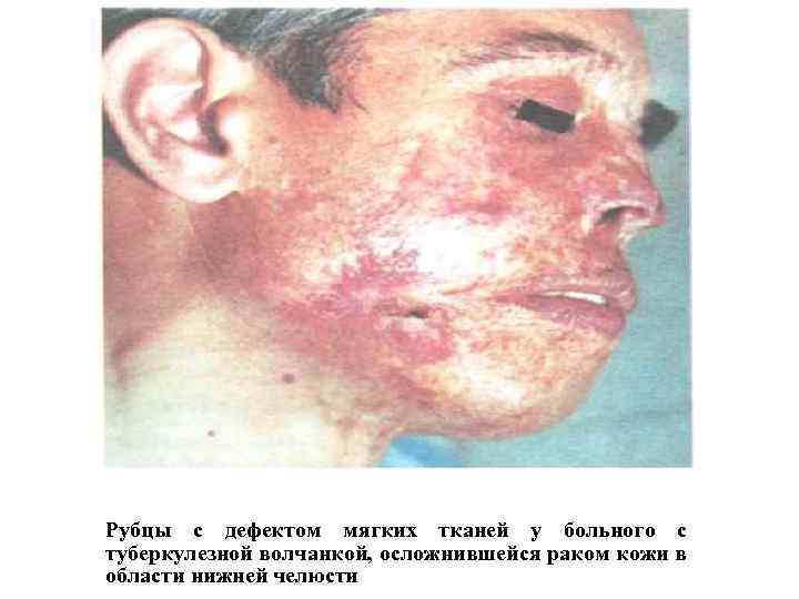 Рубцы с дефектом мягких тканей у больного с туберкулезной волчанкой, осложнившейся раком кожи в