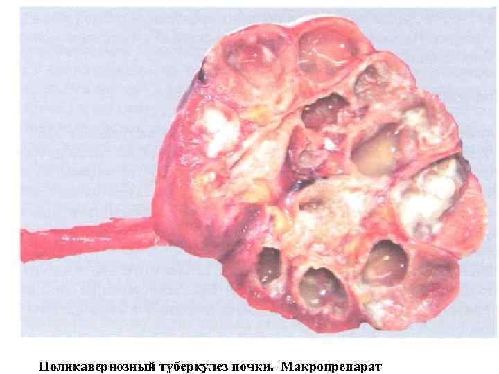 Поликавернозный туберкулез почки. Макропрепарат 