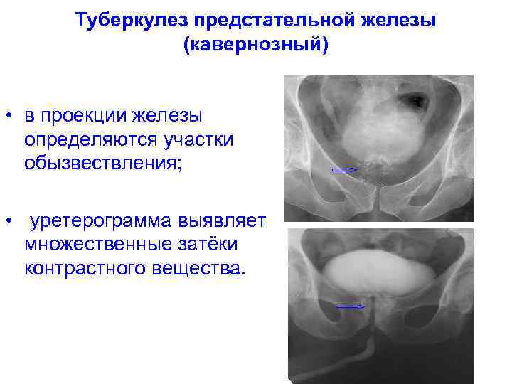 Туберкулез предстательной железы (кавернозный) • в проекции железы определяются участки обызвествления; • уретерограмма выявляет
