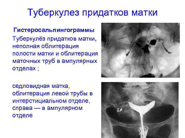 Туберкулез придатков матки Гистеросальпингограммы Туберкулёз придатков матки, неполная облитерация полости матки и облитерация маточных