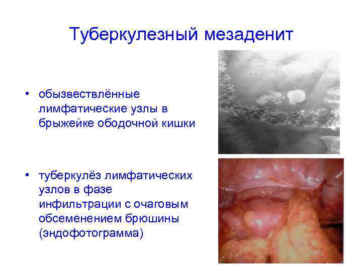 Туберкулезный мезаденит • обызвествлённые лимфатические узлы в брыжейке ободочной кишки • туберкулёз лимфатических узлов