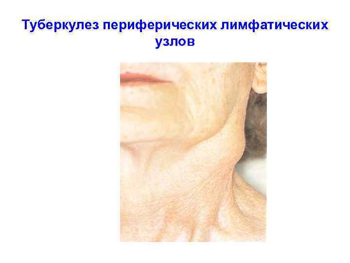 Туберкулез периферических лимфатических узлов 