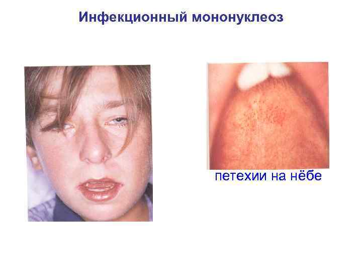 Инфекционный мононуклеоз петехии на нёбе 