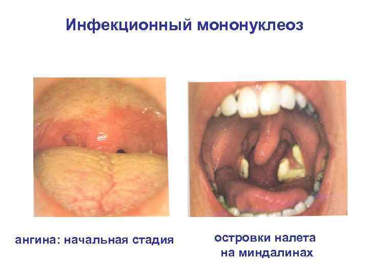 Инфекционный мононуклеоз ангина: начальная стадия островки налета на миндалинах 