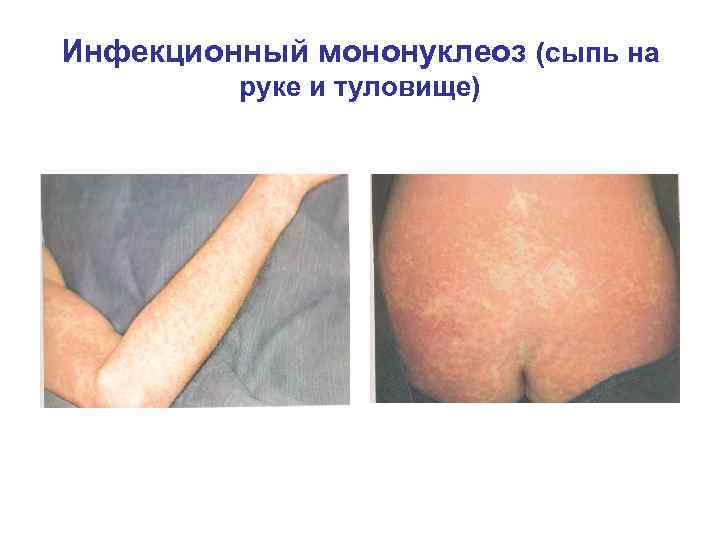 Инфекционный мононуклеоз (сыпь на руке и туловище) 