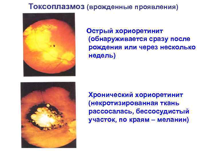 Токсоплазмоз (врожденные проявления) Острый хориоретинит (обнаруживается сразу после рождения или через несколько недель) Хронический