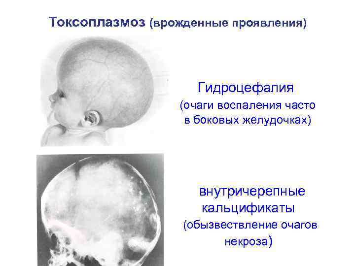 Токсоплазмоз (врожденные проявления) Гидроцефалия (очаги воспаления часто в боковых желудочках) внутричерепные кальцификаты (обызвествление очагов