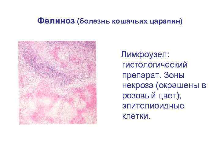 Фелиноз (болезнь кошачьих царапин) Лимфоузел: гистологический препарат. Зоны некроза (окрашены в розовый цвет), эпителиоидные